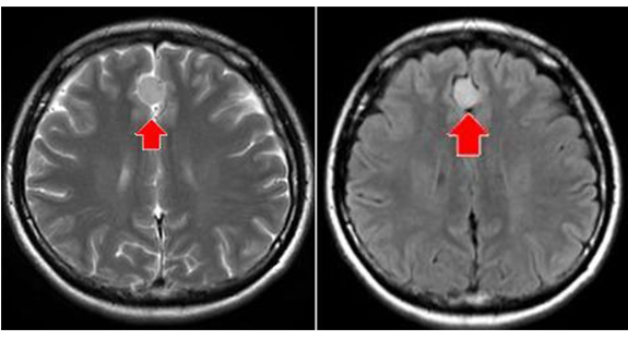 脳腫瘍（T2、フレアー）